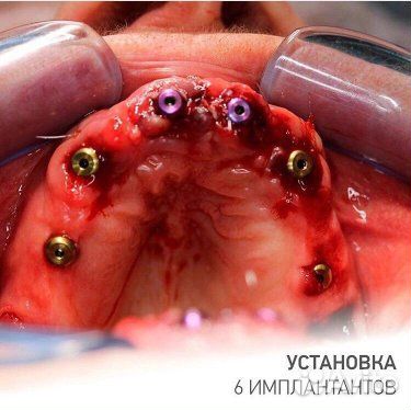Стоматология зубные протезы