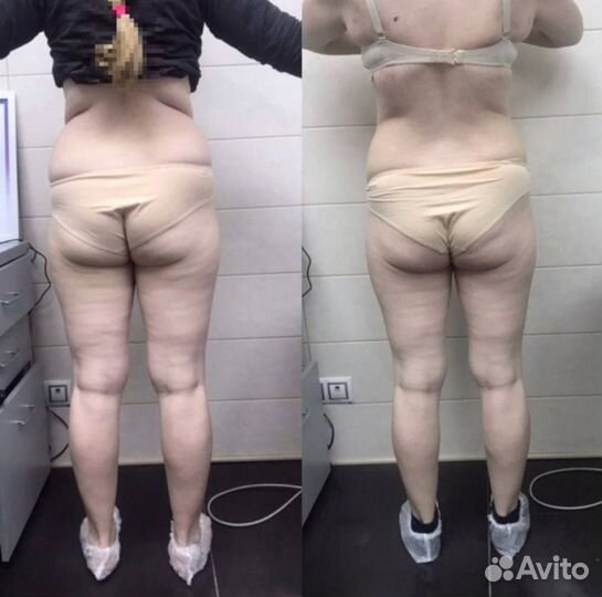 Похудение и коррекция фигуры за 4 посещния