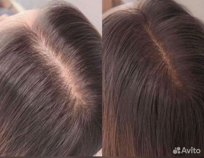 Трихопигментация, загущение волос