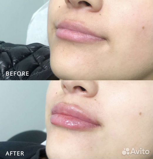Косметолог увеличение губ