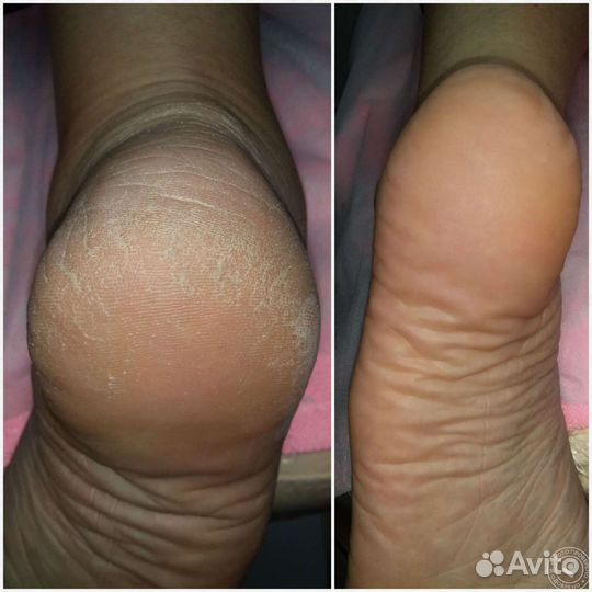 Медицинский педикюр