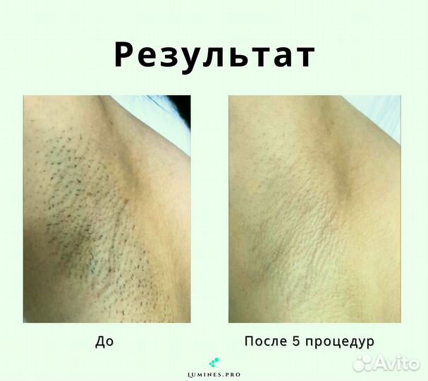 Диодный лазер для эпиляции Лю'Минес MaxOne 1200вт