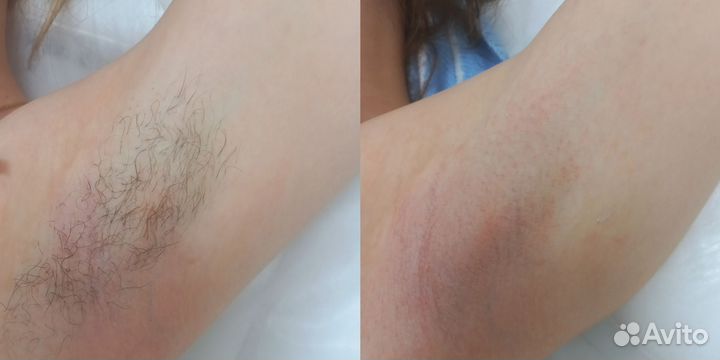 Восковая депиляция