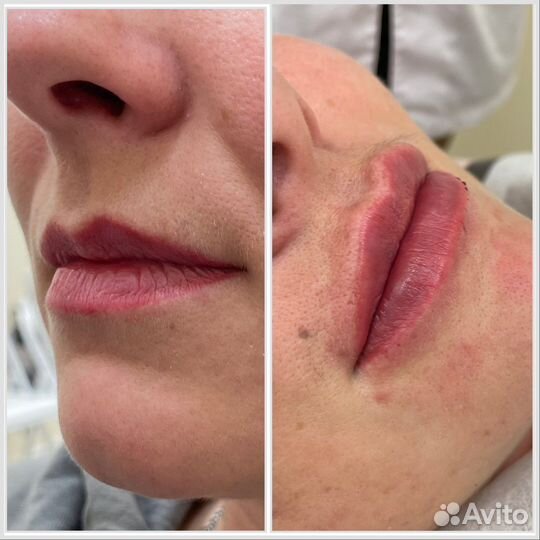 Нужны модели на процедуры по косметологии