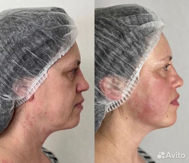 Смас лифтинг