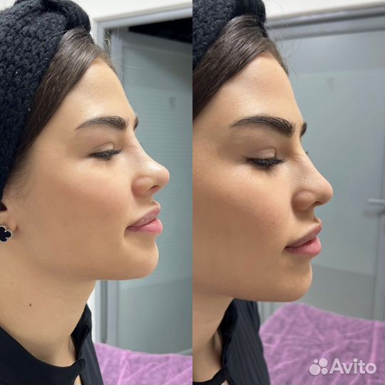 Уменьшение носика навсегда