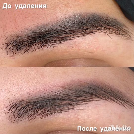 Лазерное удаление тату, татуажа бровей, губ