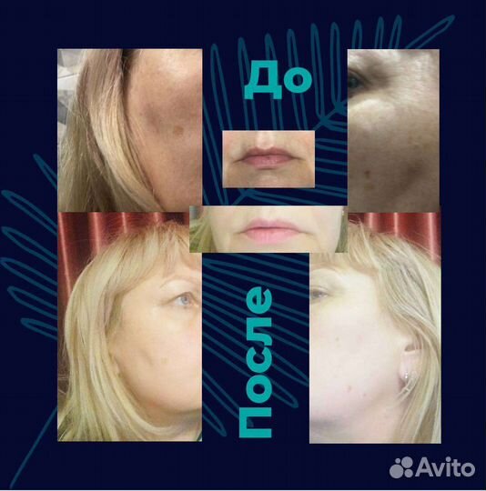 Крем от пигментации. Мирра Люкс