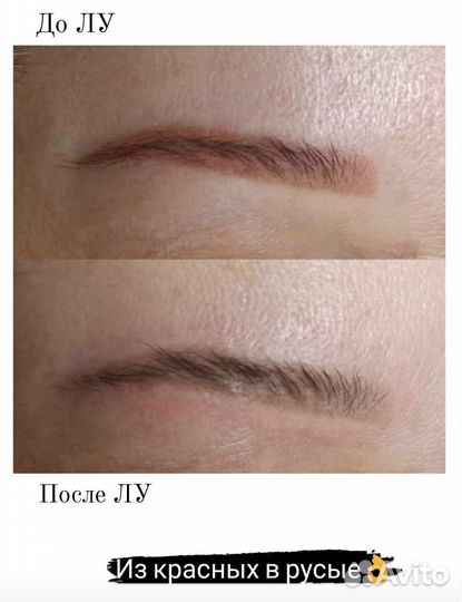 Удаление татуировок и татуажа