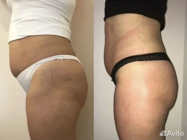 Косметолог - Кавитация, настоящий жиротоп