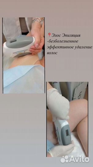 Элос эпиляция