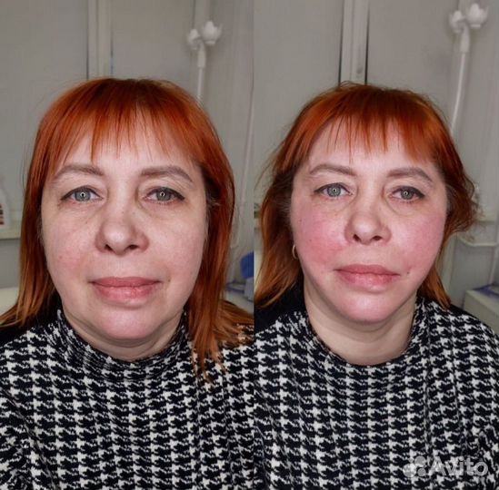 Подтяжка лица нитями ког мезонити моно