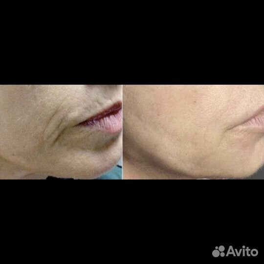 Биоревитализация мезотерапия губы