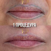 Удаление татуажа и тату лазером PicoSure пикошур, Москва