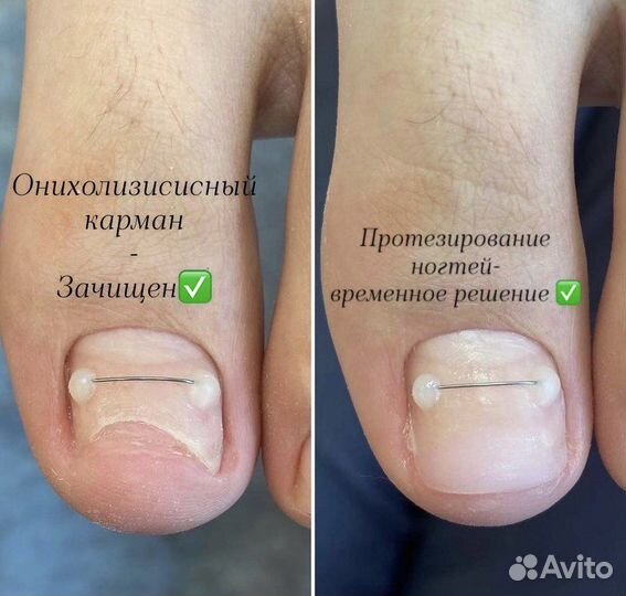 Медицинский педикюр подолог