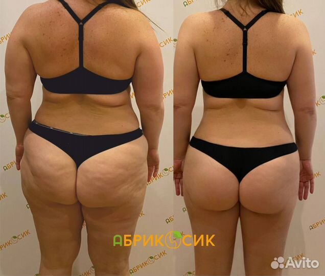 LPG массаж, эффективная коррекция фигуры