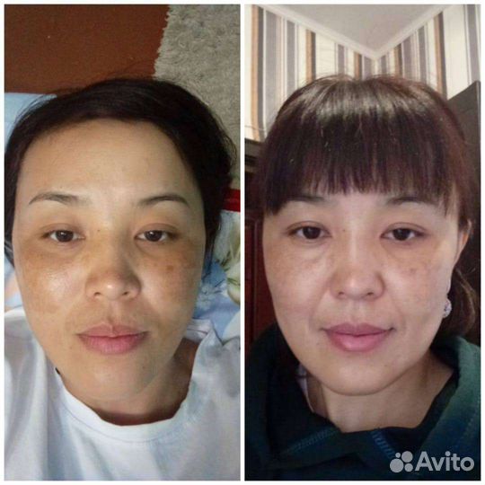 Крем от пигментации. Мирра Люкс