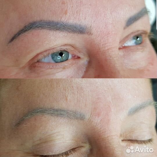 Лазерное удаление тату и перманента