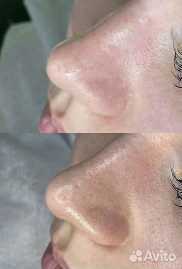 Авторский массаж лица, чистка лица, пилинг