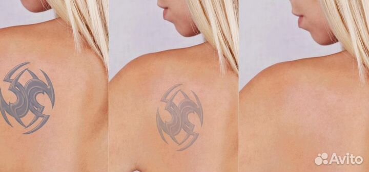 Удаление татуировок лазером