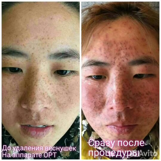 Фотоомолож-е,удаление пигментации,веснушек,купероз