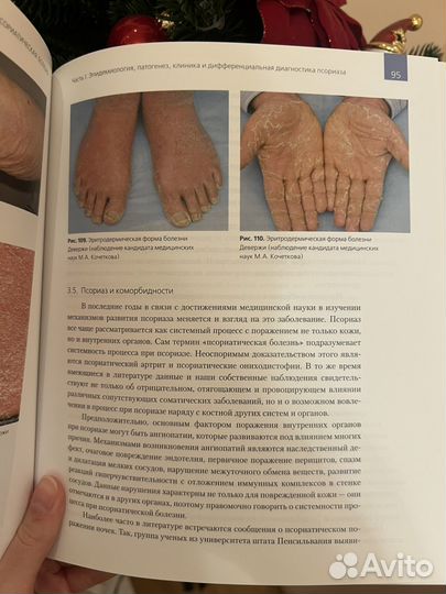 Псориатическая болезнь Потекаев, Круглова