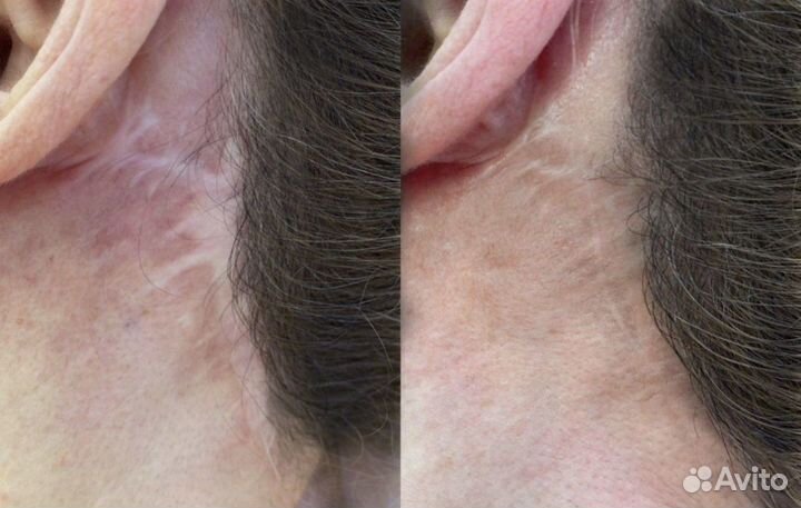 Камуфляж шрамов, растяжек, ареол