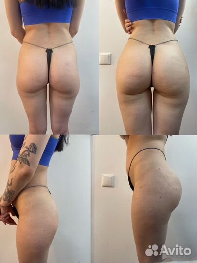 Увелечение ягодиц