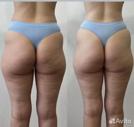 Мадеротерапия