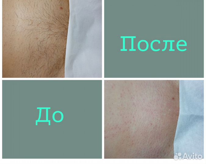 Шугаринг Депиляция Воском