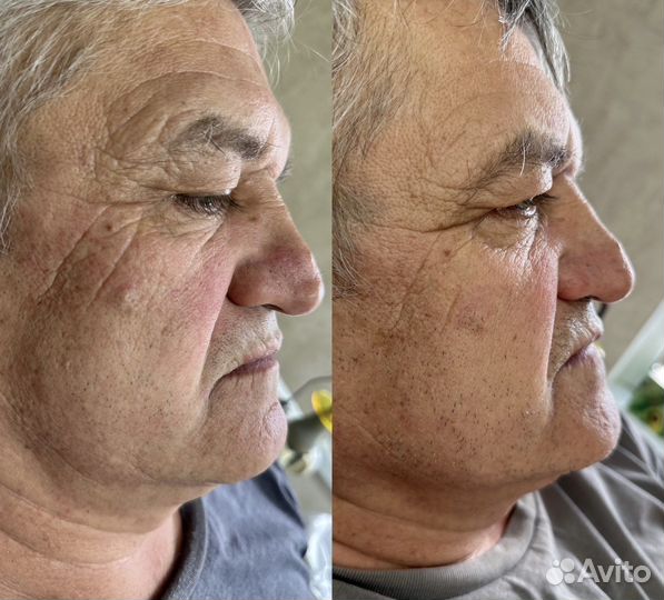 Плазменное омоложение мтуси 