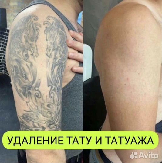 Полное удаление тату в спб