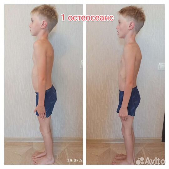 Остеопластика, массаж