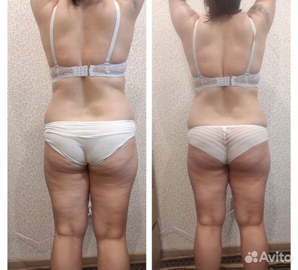 Антицеллюлитный массаж