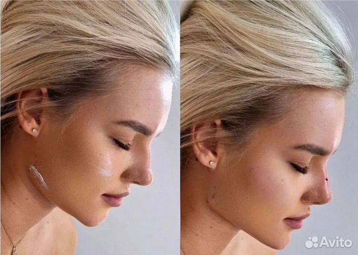 Омоложение -10 лет термолифтинг