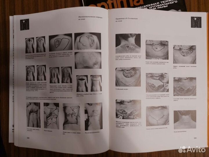 Янош Золтан - Cicatrix optima + Пересадка кожи