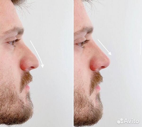 Ринопластика