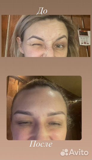 Мезотерапия волос