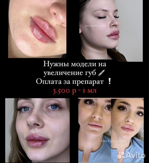 Увеличение губ