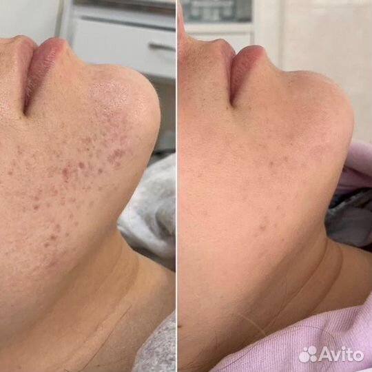 Плазмотерапия лица и головы