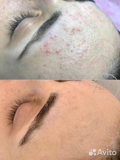 Косметолог, чистка лица, подбор домашнего ухода