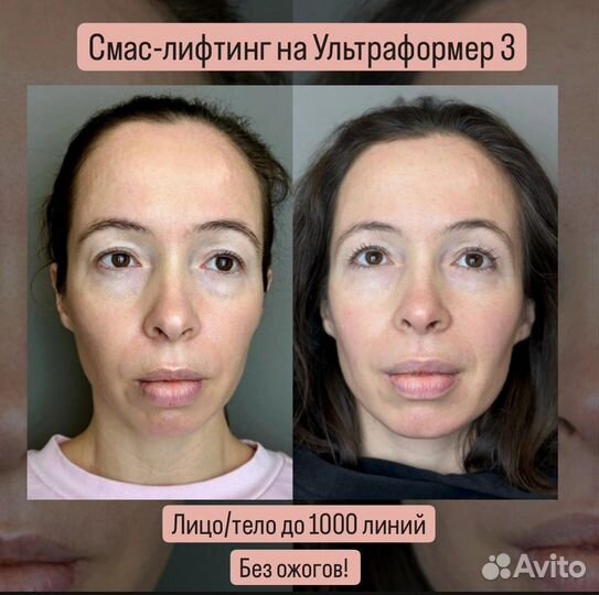 СМАС лифтинг. Аппарат Ультраформер 3