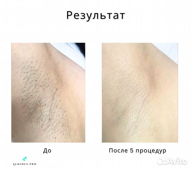 Диодный лазер Lumines’ Max’Plus 2000в