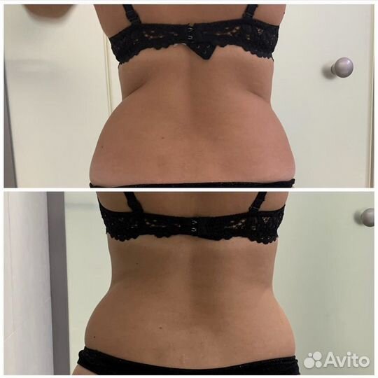 Антицеллюлитный массаж похудение