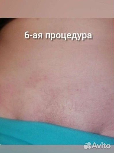 Электроэпиляция
