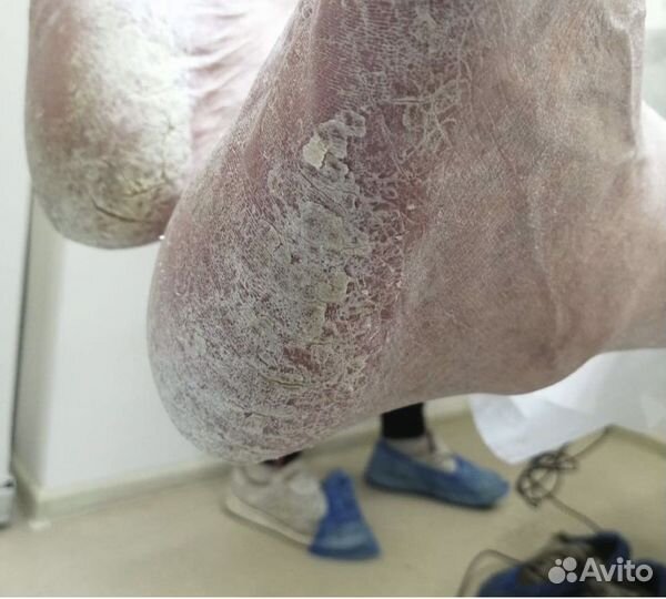 Лечебный педикюр подолог