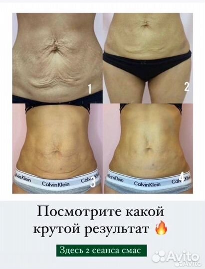 Подтяжка живота