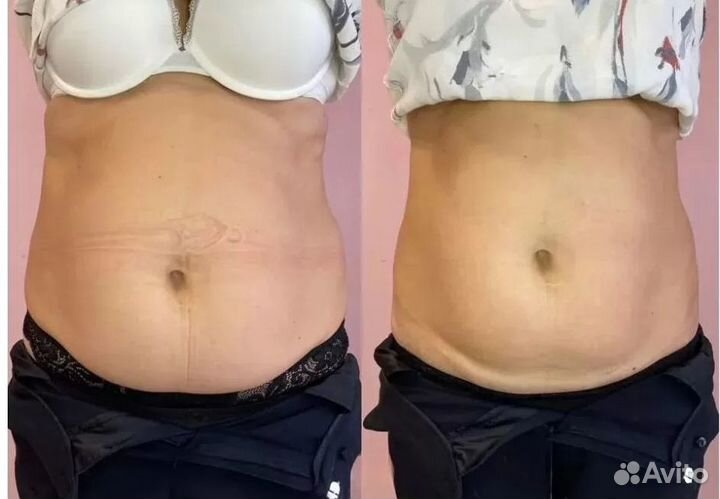 Модель на криолиполиз