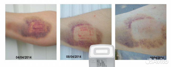 Электронейростимулятор Чэнс-01-М «Скэнар»