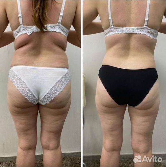 LPG массаж, Классический, Кавитация,smas-лифтинг